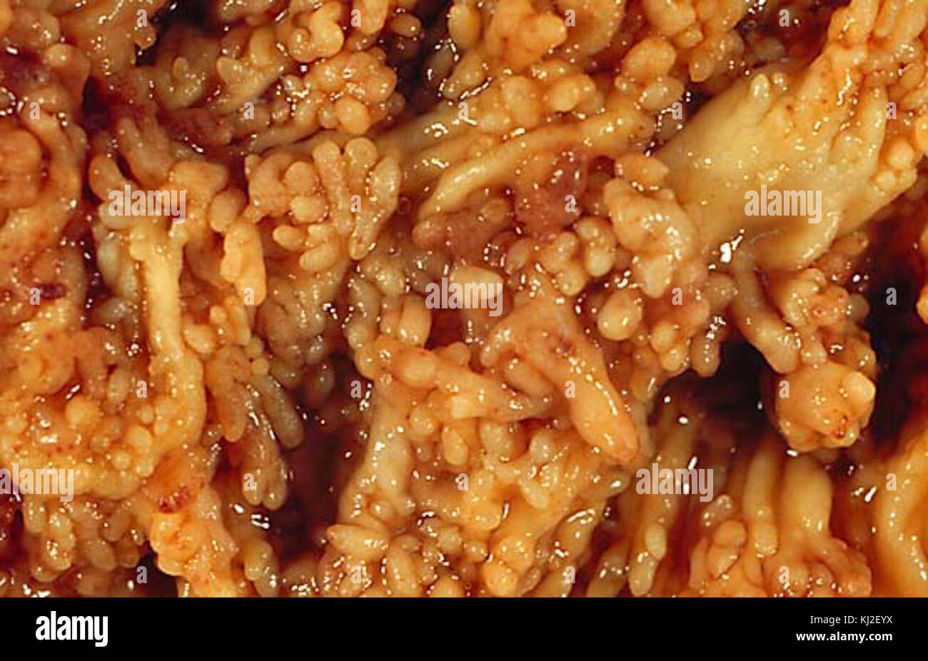 Malattie croniche colite ulcerosa 1 Foto Stock