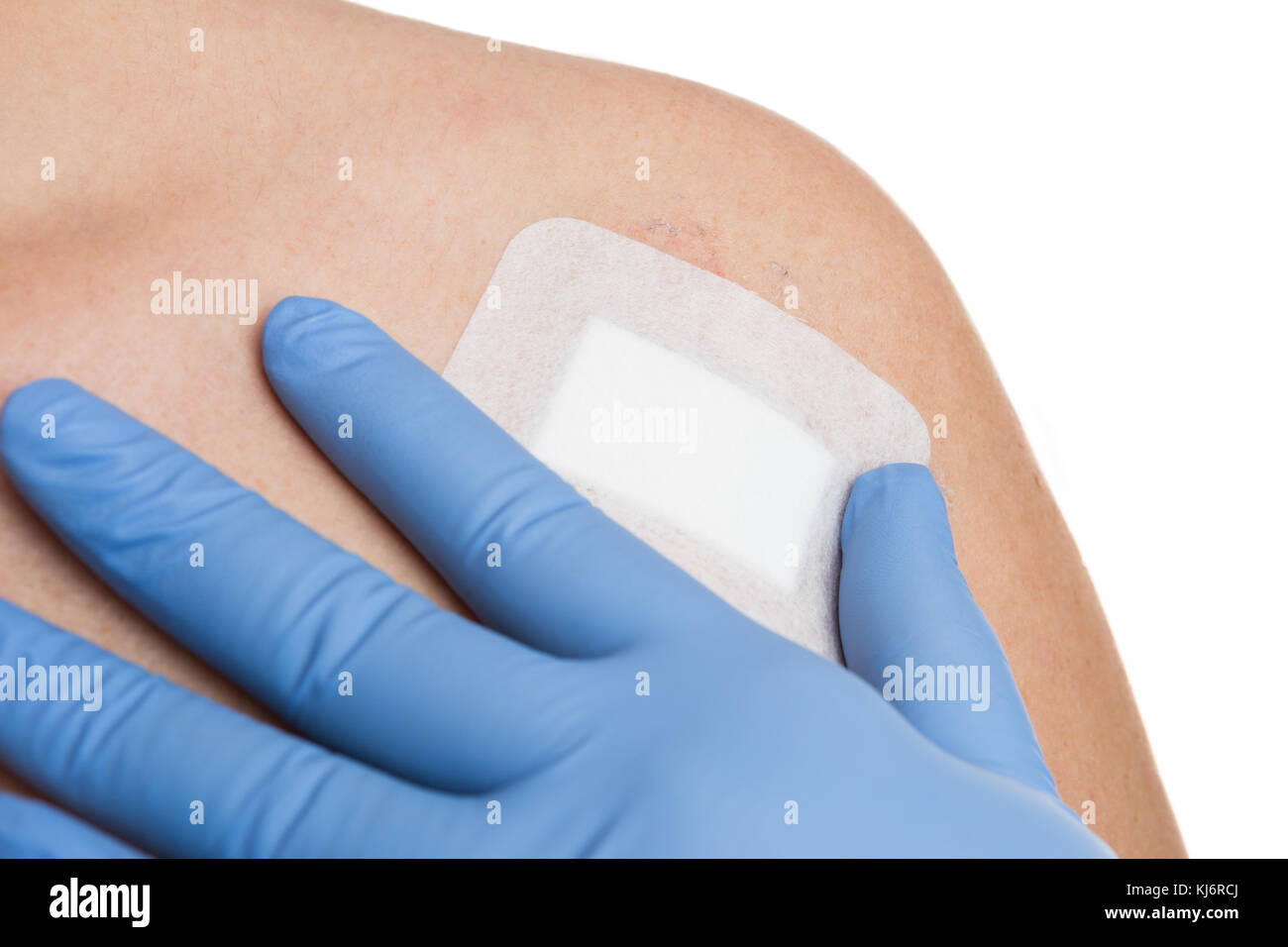 Medico mano con i guanti chirurgici controllo chirurgia con patch avvolto dopo la spalla femminile mole distacco Foto Stock
