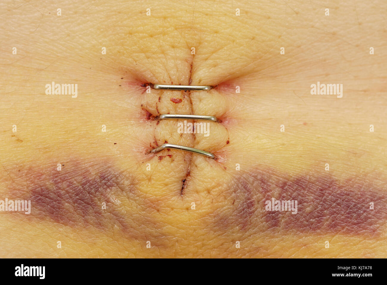 Surgical staples immagini e fotografie stock ad alta risoluzione - Alamy