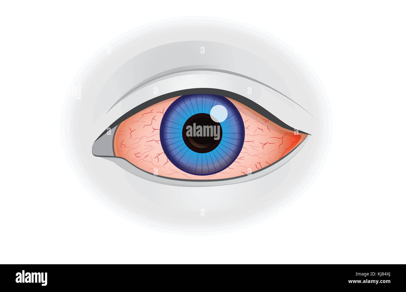 Arrossamento degli occhi il sintomo di umana isolata su bianco. Illustrazione Vettoriale