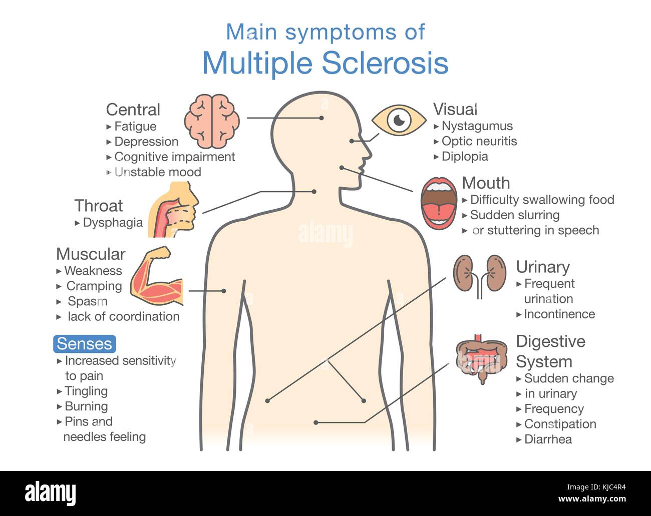 Principali sintomi della sclerosi multipla. Illustrazione Vettoriale