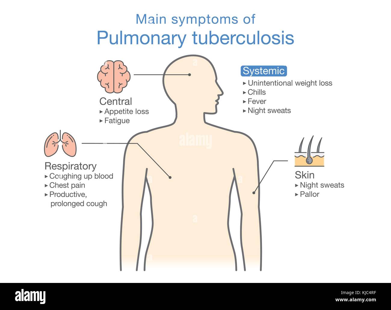 Principali sintomi di tubercolosi polmonare del paziente. Illustrazione Vettoriale