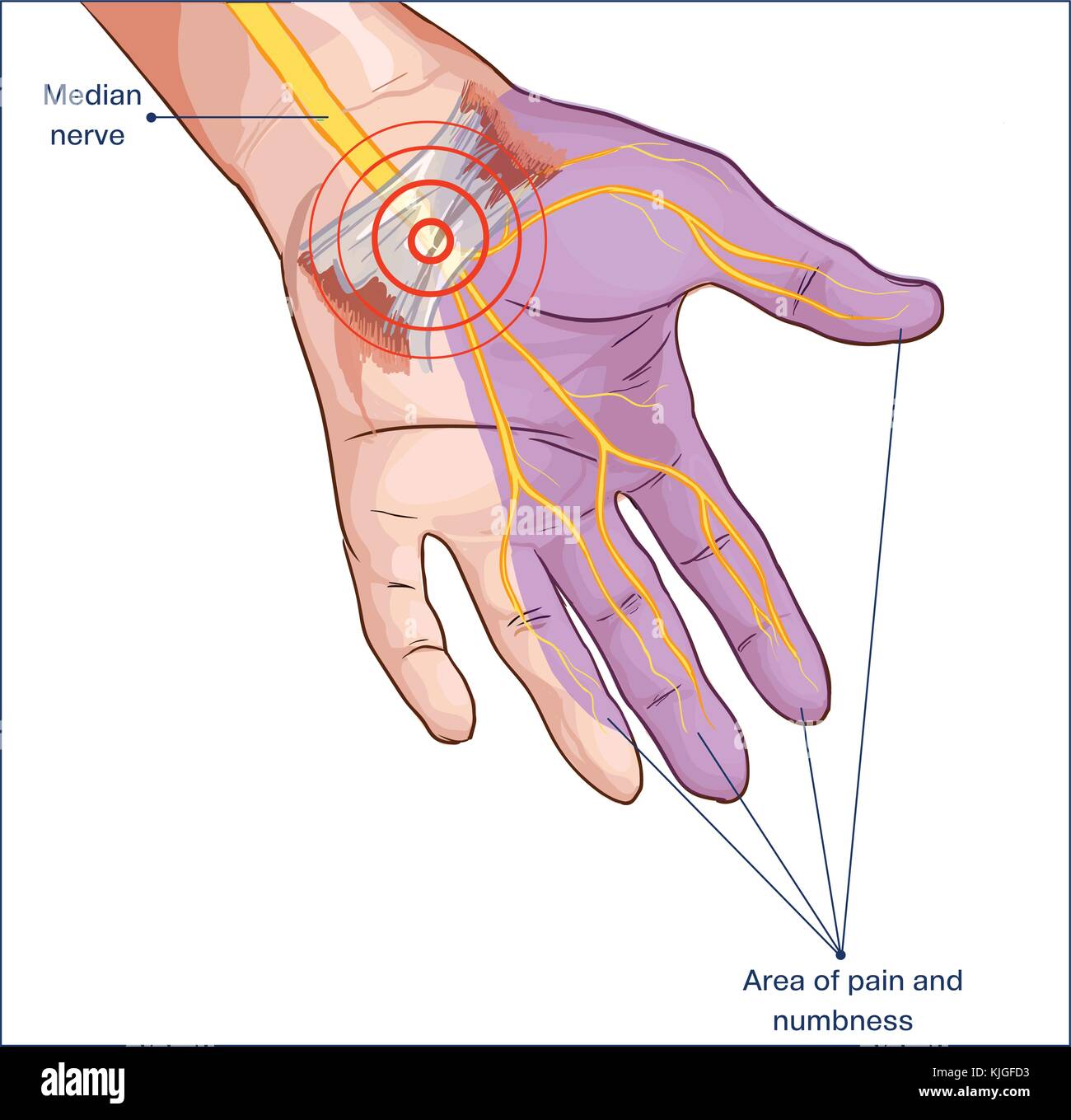 Legamento trasverso del carpo compressa nervo mediano mano Illustrazione Vettoriale