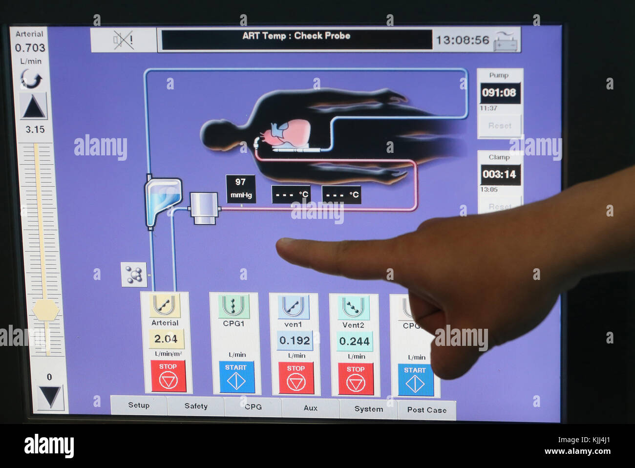 Teatro operativo. Il monitoraggio. Per Cardioplegia. Il Vietnam. Foto Stock