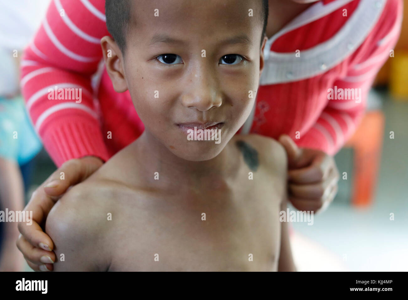 Free health clinic gestito dalle Suore Francescane Missionarie di Maria. La minoranza etnica bambino. Dalat. Il Vietnam. Foto Stock