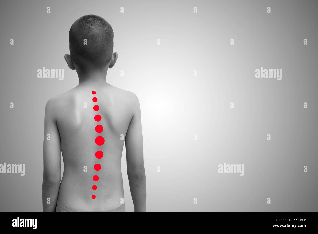 La scoliosi nei bambini Foto Stock