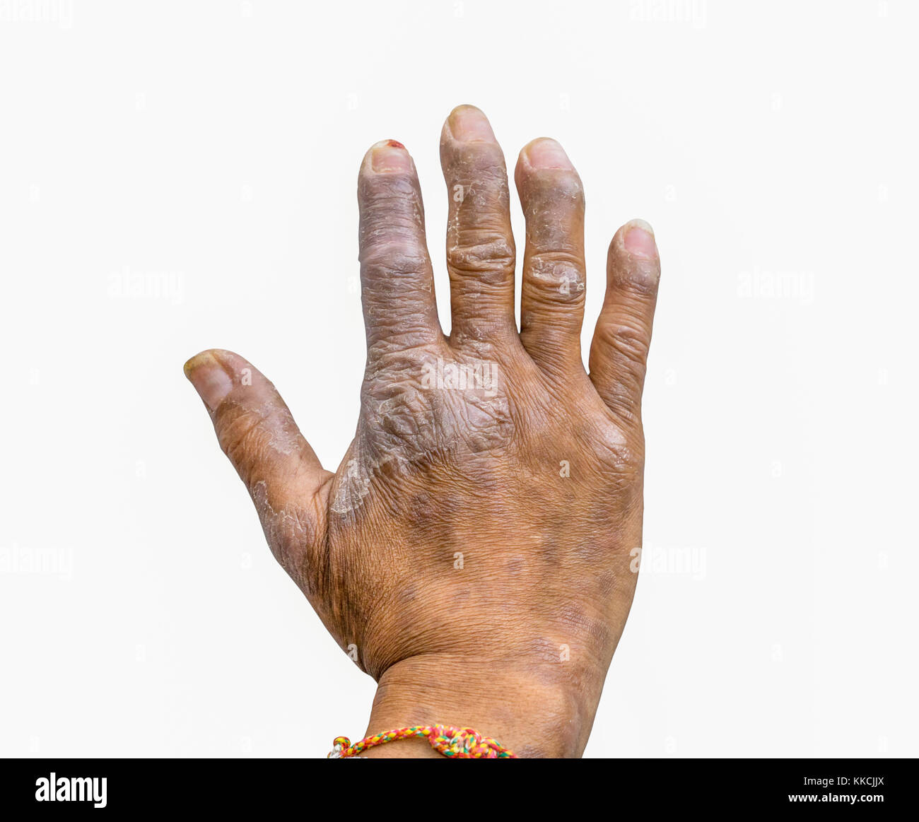 Primo piano della psoriasi alle mani degli agricoltori isolati su sfondo  bianco, dermatologia malattie della pelle. La psoriasi dita deformità Foto  stock - Alamy