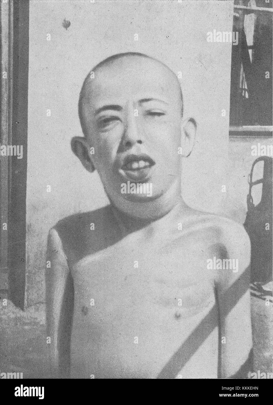 Fotografia della ricerca clinica sulla malattia della fame condotta durante la carestia del 1942 nel ghetto di Varsavia. Foto Stock