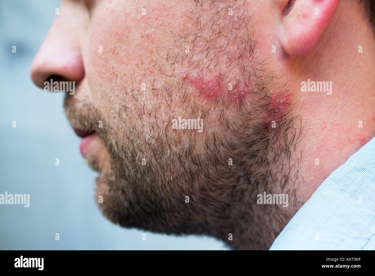 Rash reazione da farmaco o allergia alimentare sul volto di uomo caucasico Foto Stock