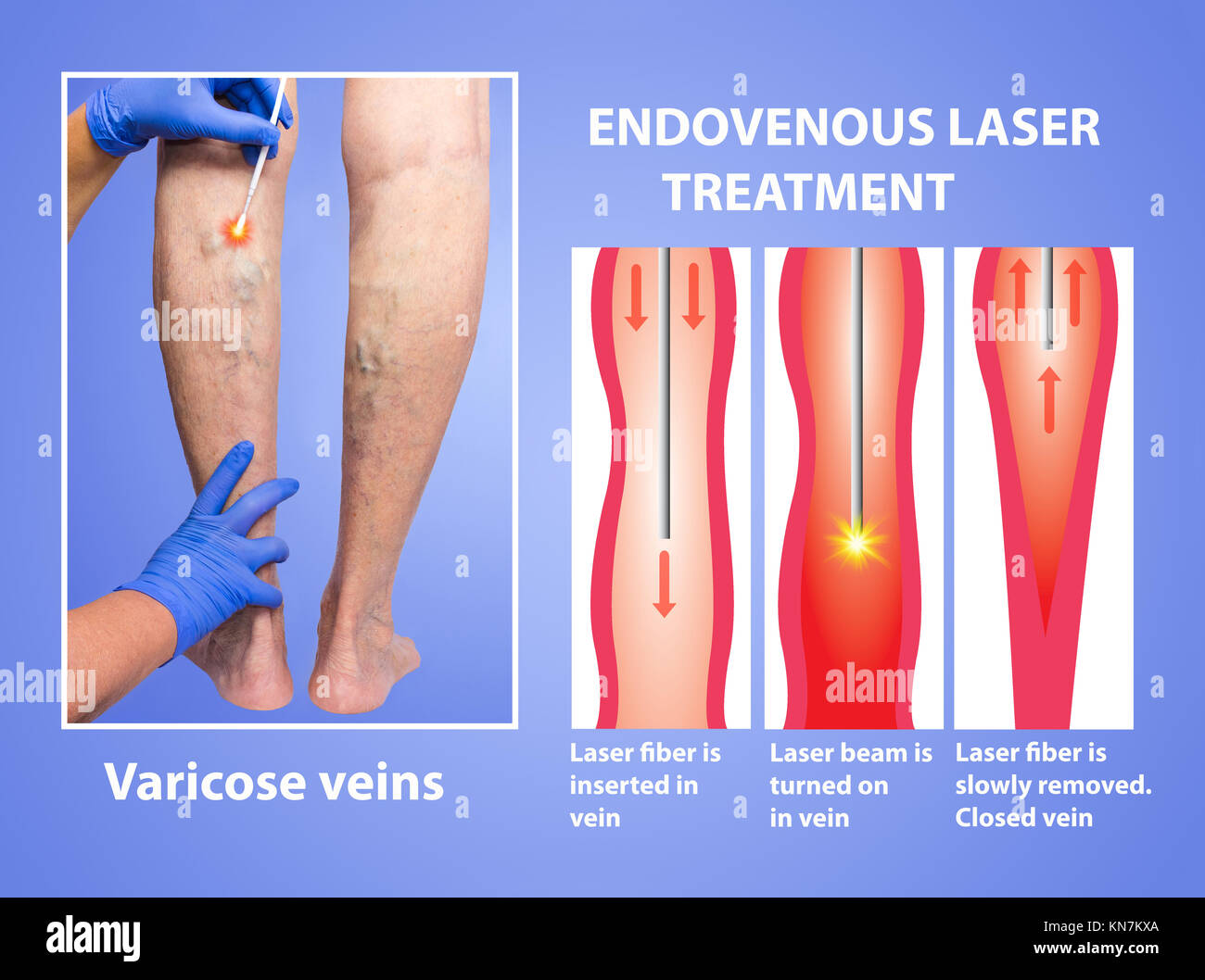 Vene varicose. Trattamento con laser endovenoso delle gambe femmina Foto  stock - Alamy