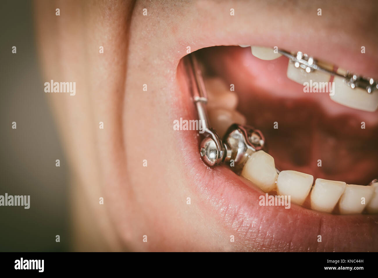 Apparecchio dentale per il morso profondo Foto stock - Alamy