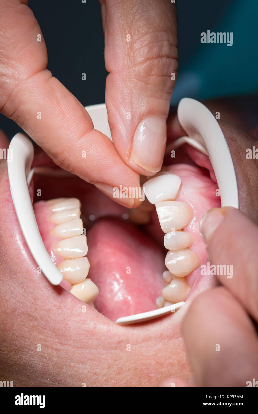 Faccette dentali poste da un dentista. Foto Stock