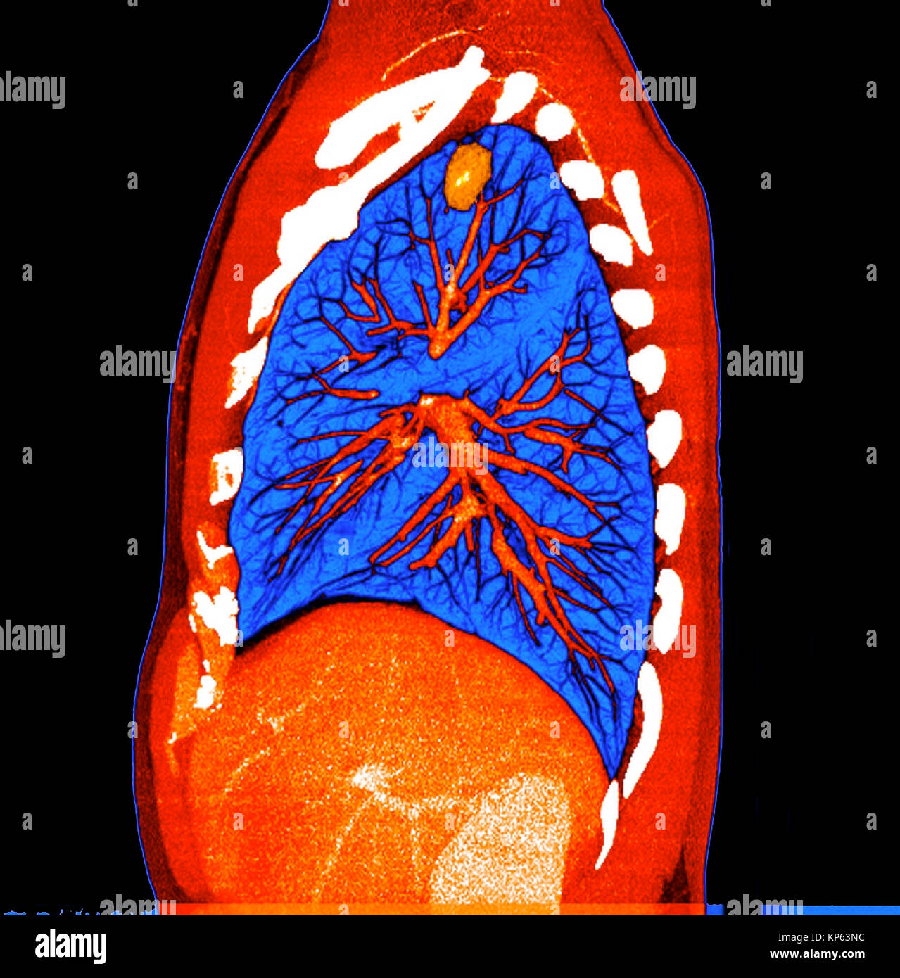 CTscan colorati della parte superiore del torace che mostra un tumore del polmone. Foto Stock
