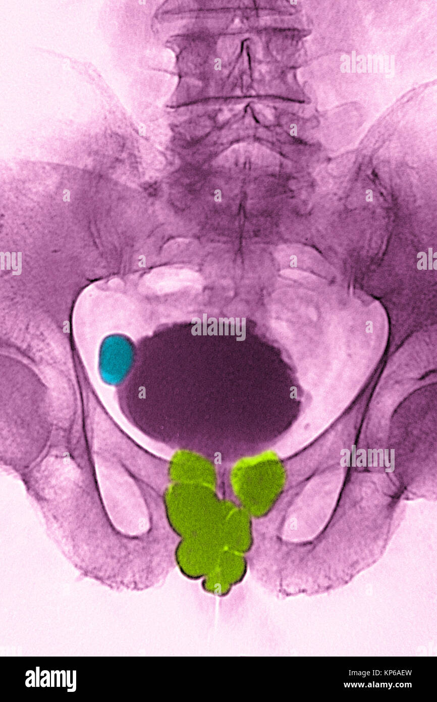 Antro della prostata Foto Stock