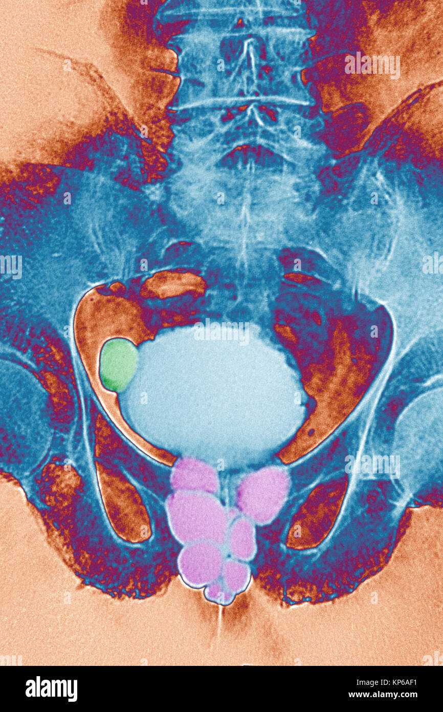 Antro della prostata Foto Stock