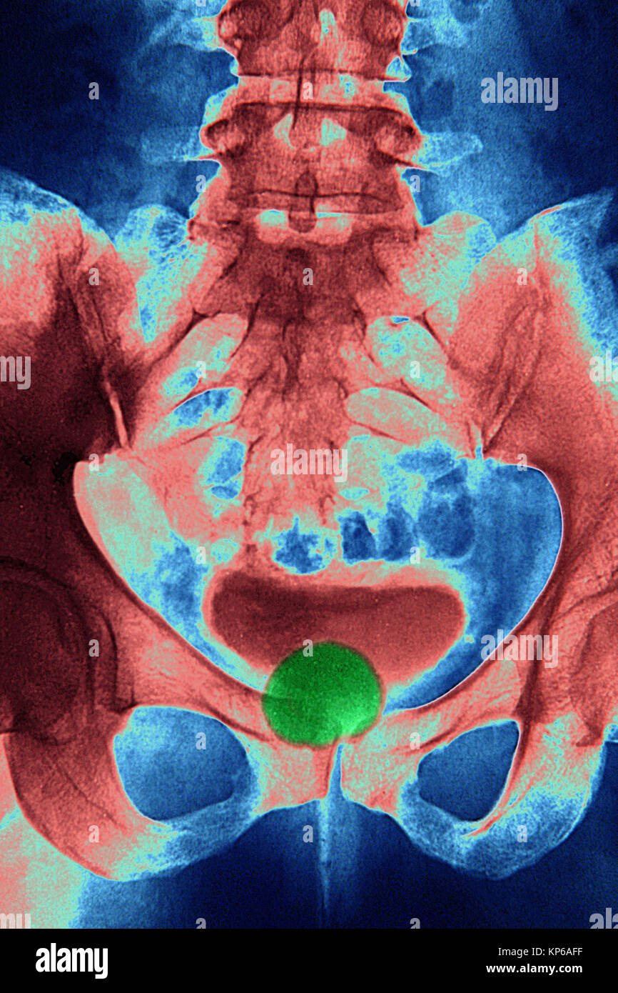 DIVERTICULUM nella vescica, RAGGI X Foto Stock