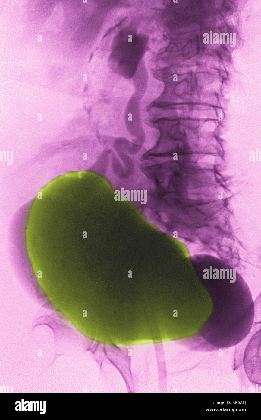 DIVERTICULUM nella vescica, RAGGI X Foto Stock