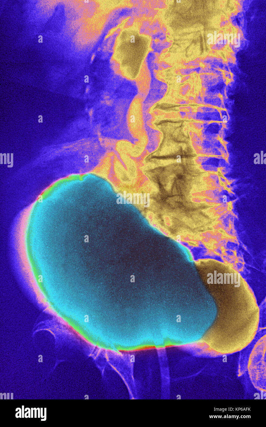 DIVERTICULUM nella vescica, RAGGI X Foto Stock