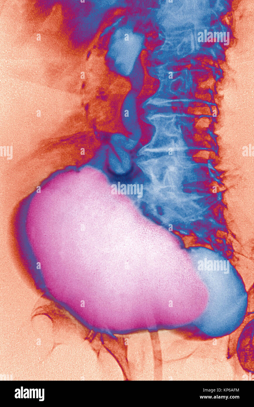 DIVERTICULUM nella vescica, RAGGI X Foto Stock