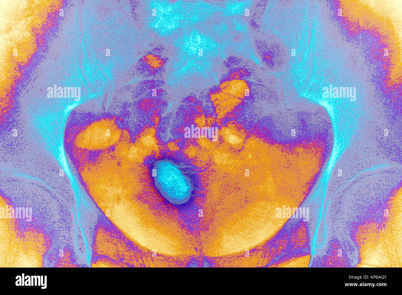 Il tartaro vescicale, X-RAY Foto Stock