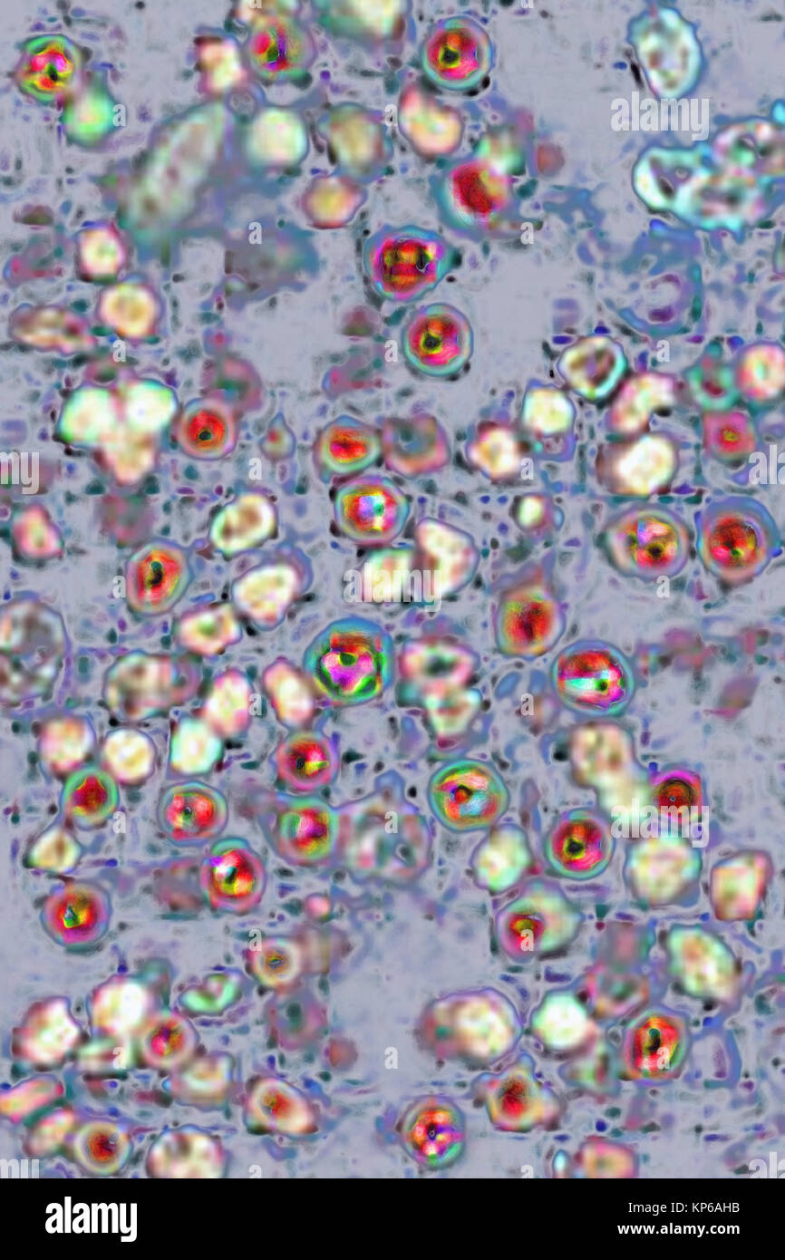 VIRUS DEL MORBILLO Foto Stock