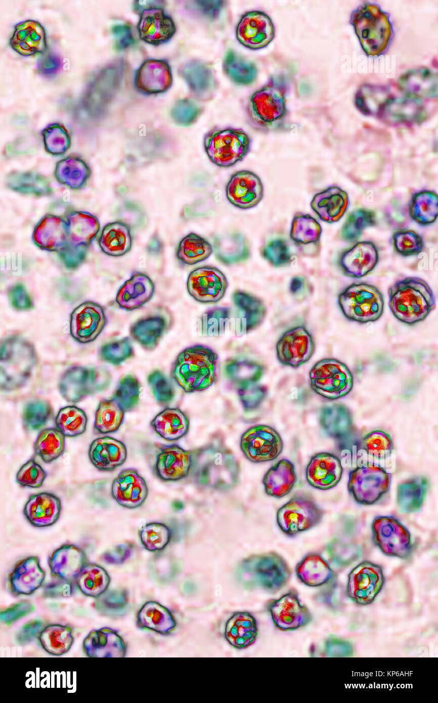 VIRUS DEL MORBILLO Foto Stock