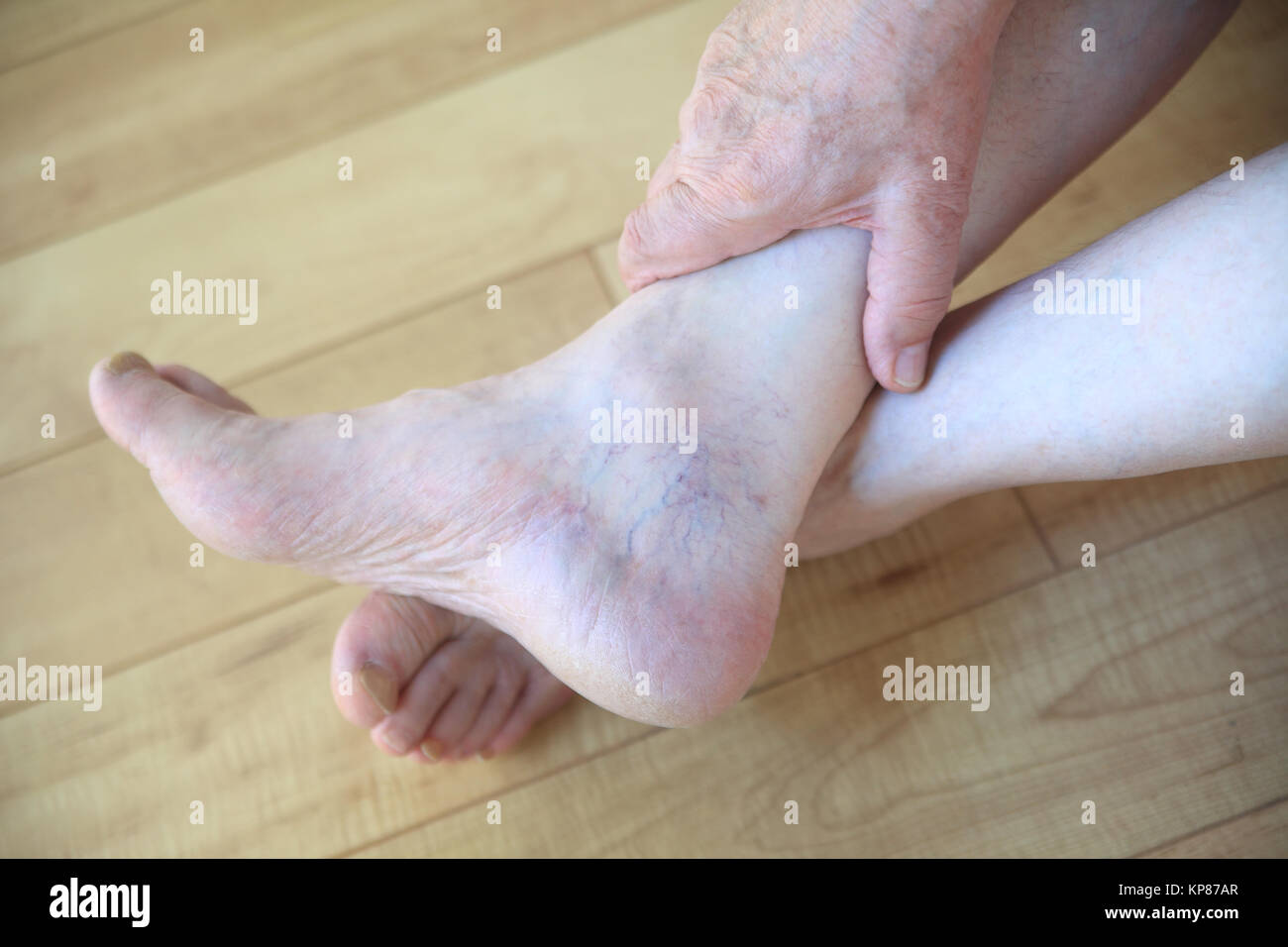 Vene a ragnatela sulla caviglia dell uomo Foto Stock