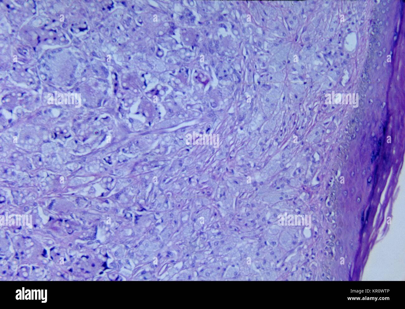 Tale micrografia mostra le variazioni istopatologiche associate con lobomycosis della pelle, 1965. Questa cronica infezione fungina è causato dal fungo Lacazia loboi, precedentemente denominato Loboa loboi, ed è caratterizzato dal fatto di keloidal nodulari lesioni che si verificano sul viso, orecchie, o delle estremità. Questa malattia è di solito si trova negli esseri umani e bottiglia di delfini dal naso a. Immagine cortesia CDC/Dott. Martin Hicklin. Foto Stock