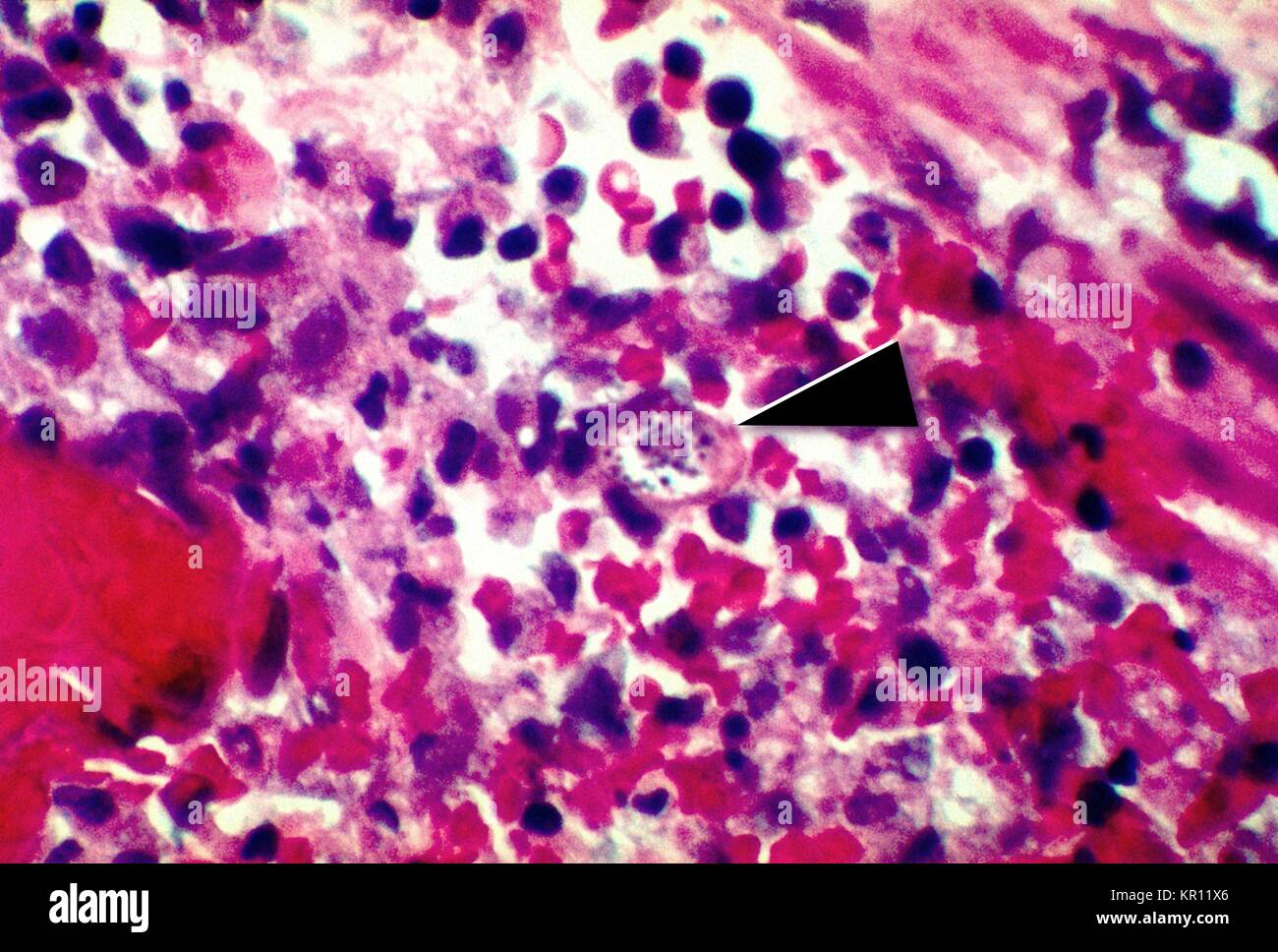 Tale micrografia rivela un Strongyloides stercoralis parassita incorporato nella mucosa intestinale, 1972. S. stercoralis è un nematode parassita che infetta gli esseri umani, primati, e cani. Il ciclo di vita è complessa, alternando tra il libero-vivente e cicli di parassiti, e include autoinfection e moltiplicazione all'interno dell'host. Immagine cortesia CDC/Dott. Fred Gilbert. Foto Stock