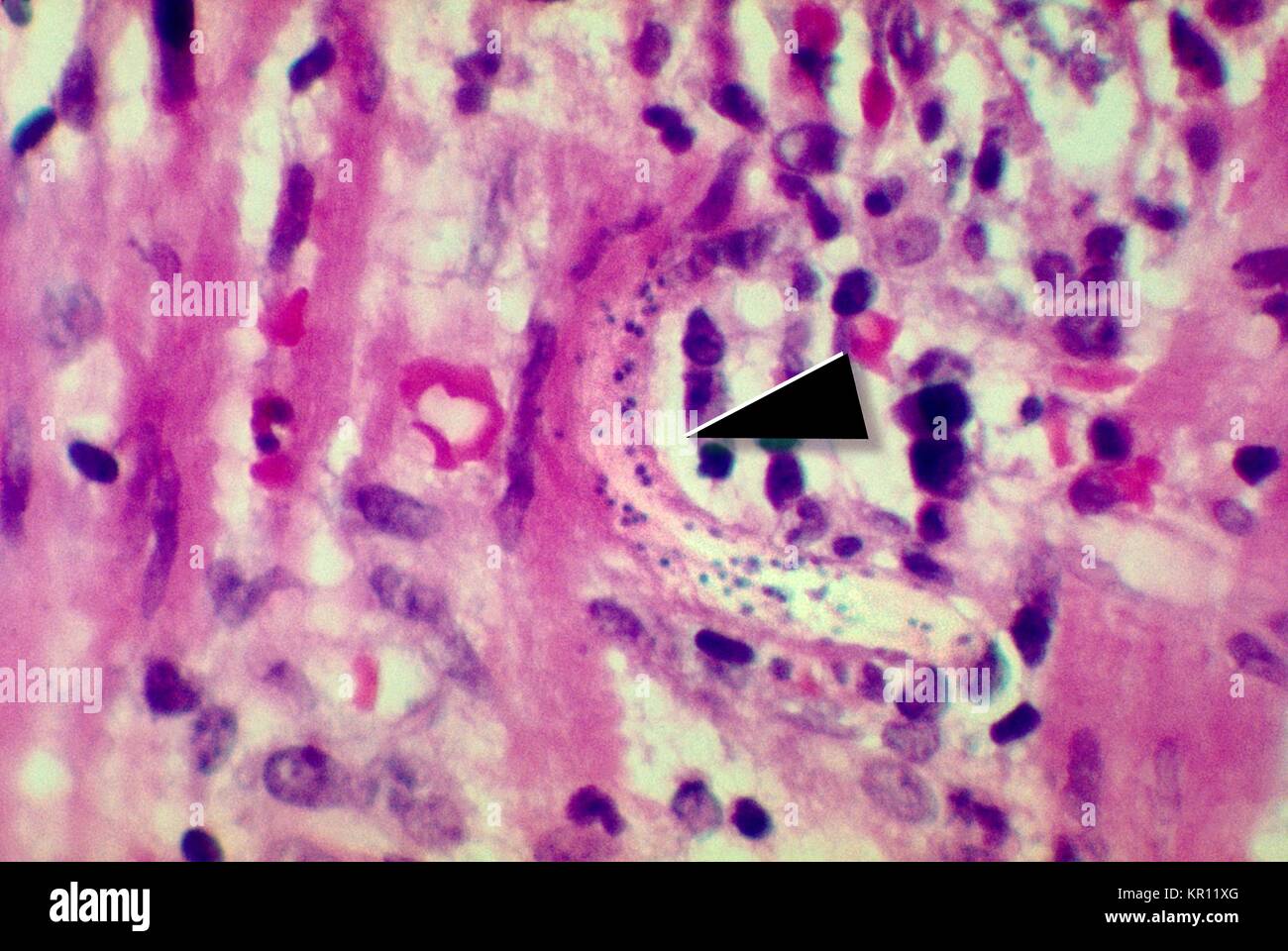 Tale micrografia rivela un Strongyloides stercoralis parassita annegata nella parete intestinale, 1972. S. stercoralis è un nematode parassita che infetta gli esseri umani, primati, e cani. Il ciclo di vita è complessa, alternando tra il libero-vivente e cicli di parassiti, e include autoinfection e moltiplicazione all'interno dell'host. Immagine cortesia CDC/Dott. Fred Gilbert. Foto Stock