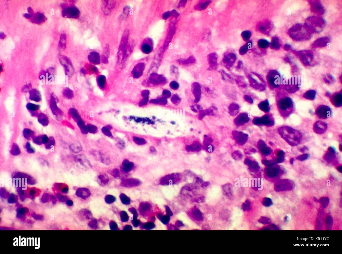 Tale micrografia mostra le variazioni istopatologiche causato da Strongyloides stercoralis annegata nella parete intestinale, 1972. S. stercoralis è un nematode parassita che infetta gli esseri umani, primati, e cani. Il ciclo di vita è con il suo complesso alternarsi tra il libero-vivente e cicli di parassiti, e il suo potenziale per autoinfection e moltiplicazione all'interno dell'host. Immagine cortesia CDC/Dott. Fred Gilbert. Foto Stock