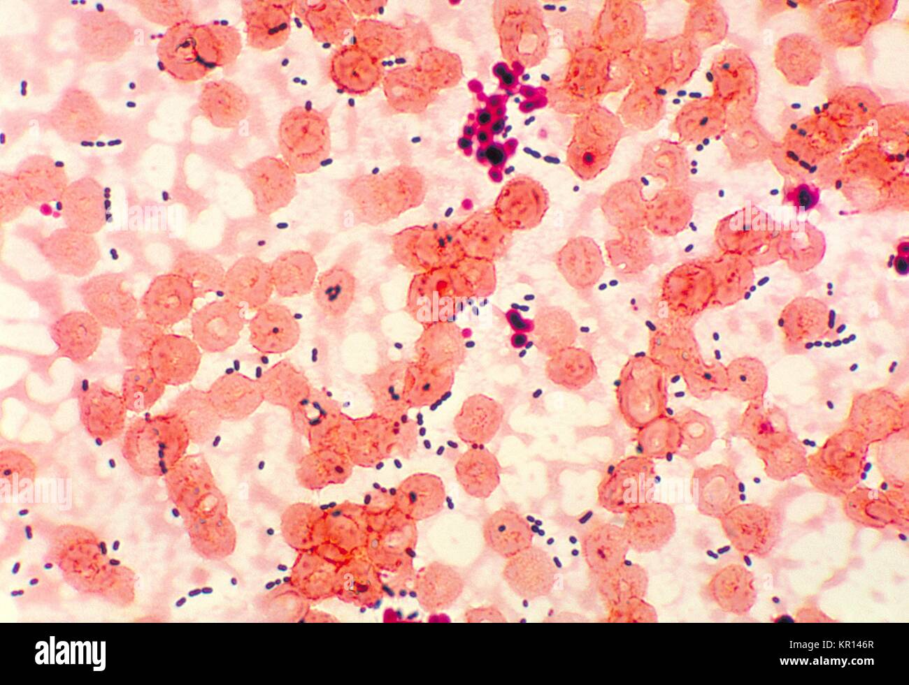 Questo fotomicrografia rivela cocci-sagomato Enterococcus sp, 1978. batteri  presi da una polmonite paziente. Enterococcus sp. è un comune di batteri  gram-positivi che possono essere normalmente trovati nell intestino e  femmina genitale. Questi