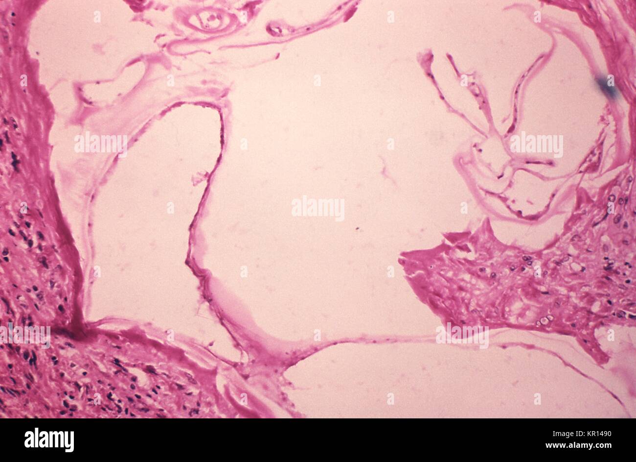 Questo fotomicrografia rivela la presenza di Echinococcus vogeli presi da un gorilla presso il Los Angeles Zoo, 1978. Il stadio larvale dei microscopici tenia Echinococcus vogeli è uno degli agenti causativi della idatidosi alveolare di malattia o di AHD. Infezione nell'uomo provoca tumori parassita per formare principalmente nel fegato, ma possono essere visualizzati anche in altri organi. Immagine cortesia CDC/Dott. Peter Schantz hanno. Foto Stock