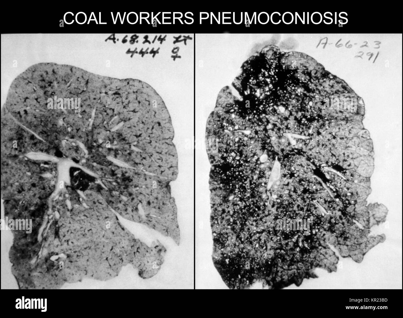 Questo salute immagine mostra i polmoni di un lavoratore di carbone con sclerogena o nero malattia polmonare, 1973. Pneumoconiosi, nero o malattia polmonare, è un lavoro di malattia correlate causato dalla continua esposizione a quantità eccessive di miniera di carbone di polvere. Questa polvere diventa inglobato nei polmoni, causando loro di indurire, rendendo la respirazione molto difficile. Immagine cortesia CDC. Foto Stock