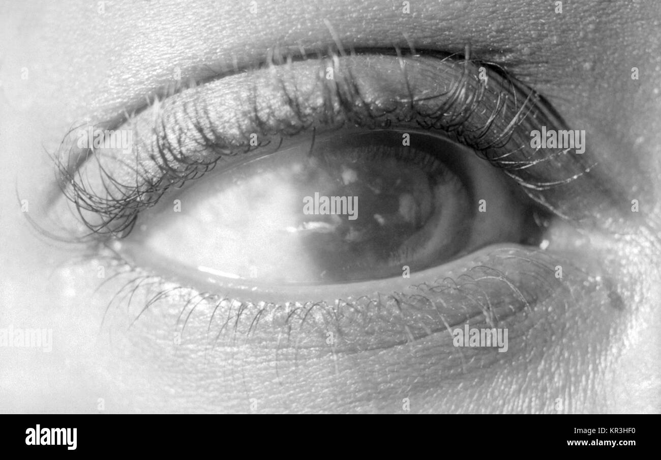Una fotografia di un paziente con la sifilide congenita che esibisce interstiziale cheratite corneale. Questo paziente?s syphilitic congenita malattia ha comportato l'insorgenza di cheratite interstiziale, una infiammazione del tessuto connettivo struttura della cornea, 1966. La sifilide è la causa più comune di questa condizione. Immagine cortesia CDC/Richard Deitrick. Foto Stock