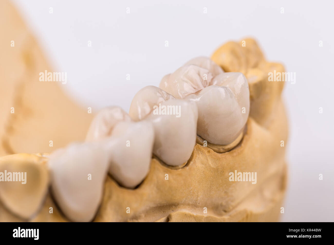 Dentiera realizzata in ceramica Foto Stock