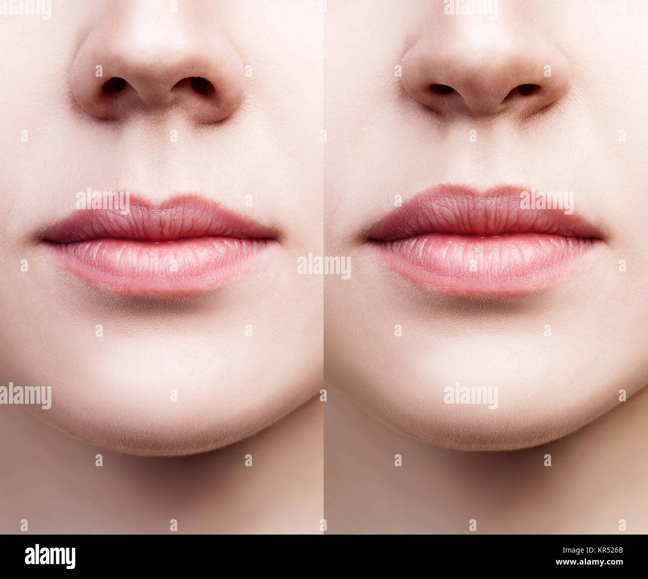 Vista frontale sul naso femminile prima e dopo la chirurgia. Foto Stock