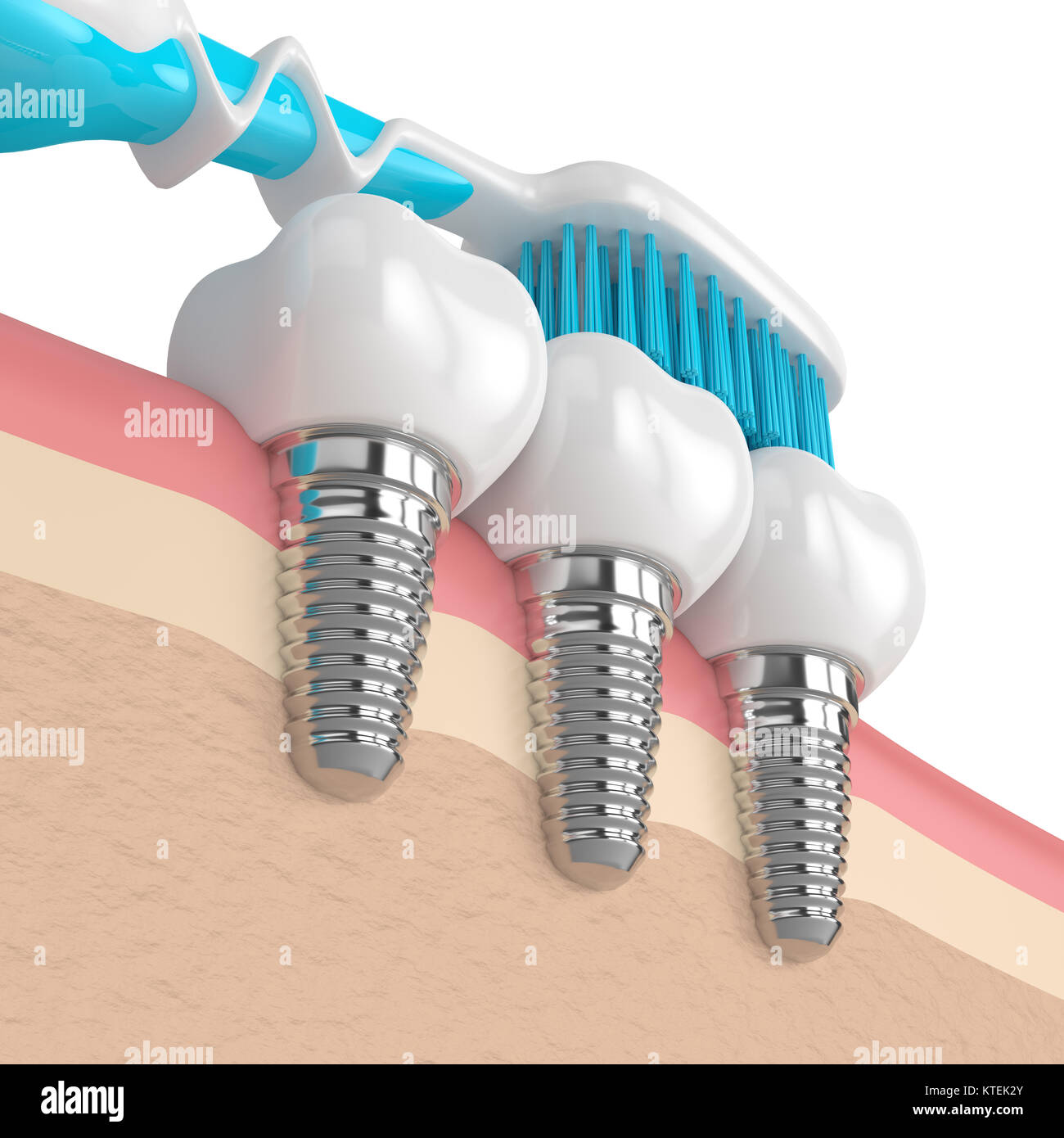 3D render di impianti dentali in gomme con spazzolino da denti Foto Stock