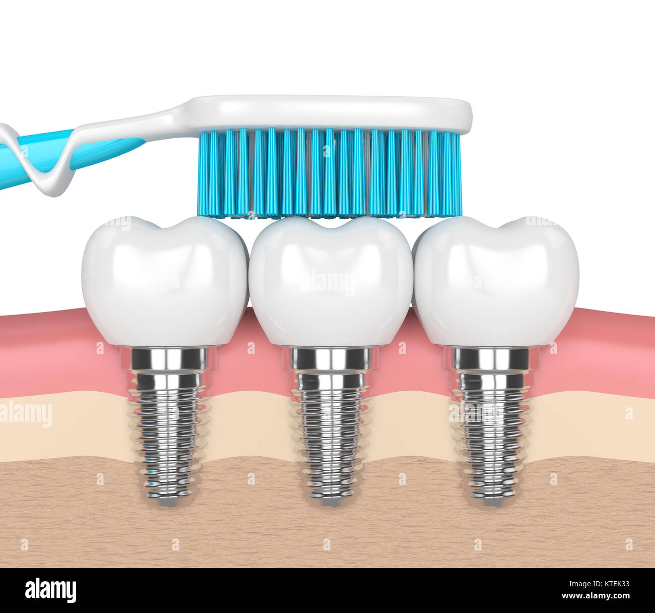 3D render di impianti dentali in gomme con spazzolino da denti Foto Stock