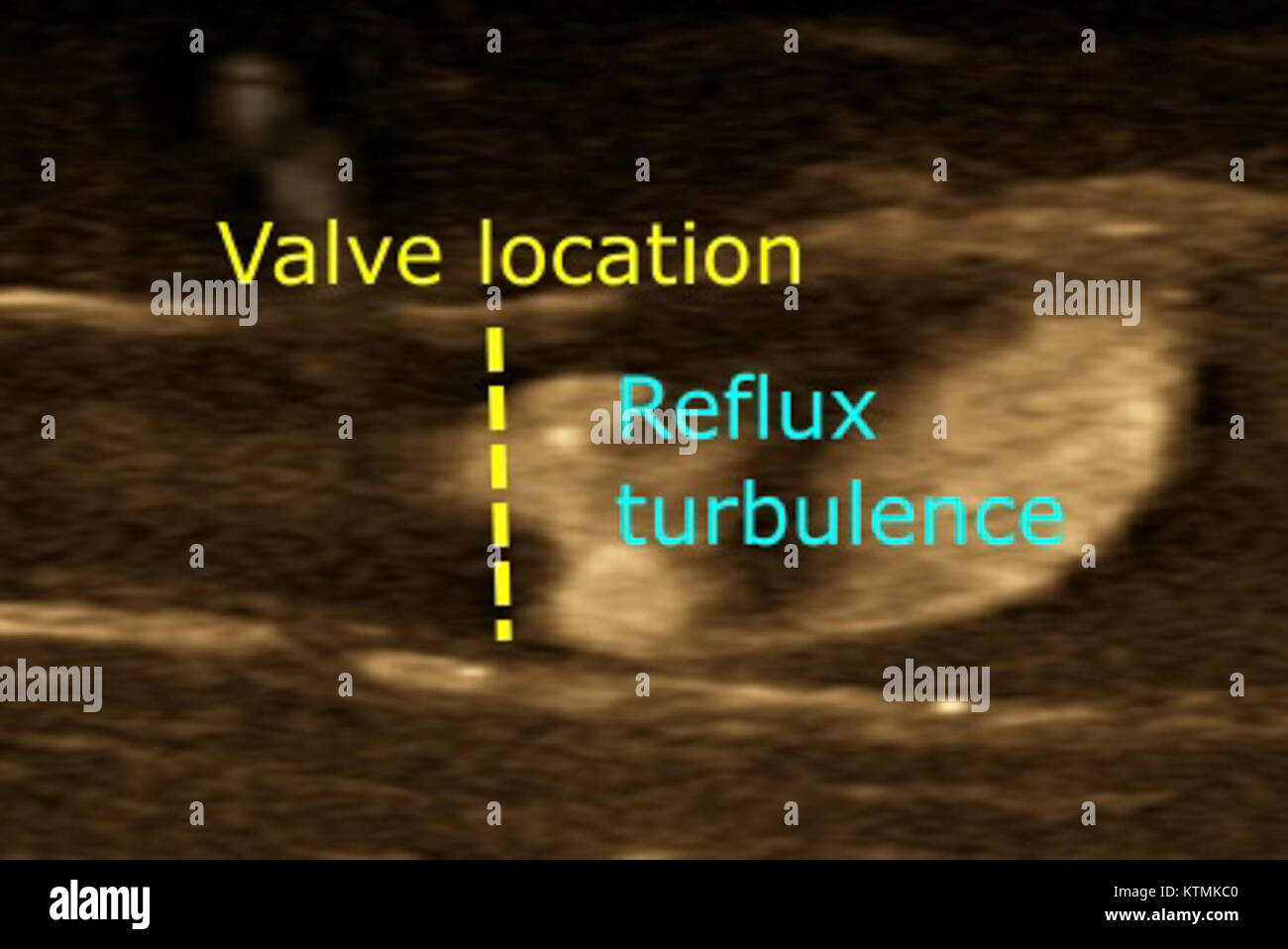 B flusso ultrasonografia è una tecnica di imaging medico utilizzato per valutare il reflusso venoso, una condizione in cui il sangue scorre indietro nelle vene, comunemente influenzando le gambe. Aiuta a diagnosticare problemi vascolari e a guidare i piani di trattamento. Foto Stock