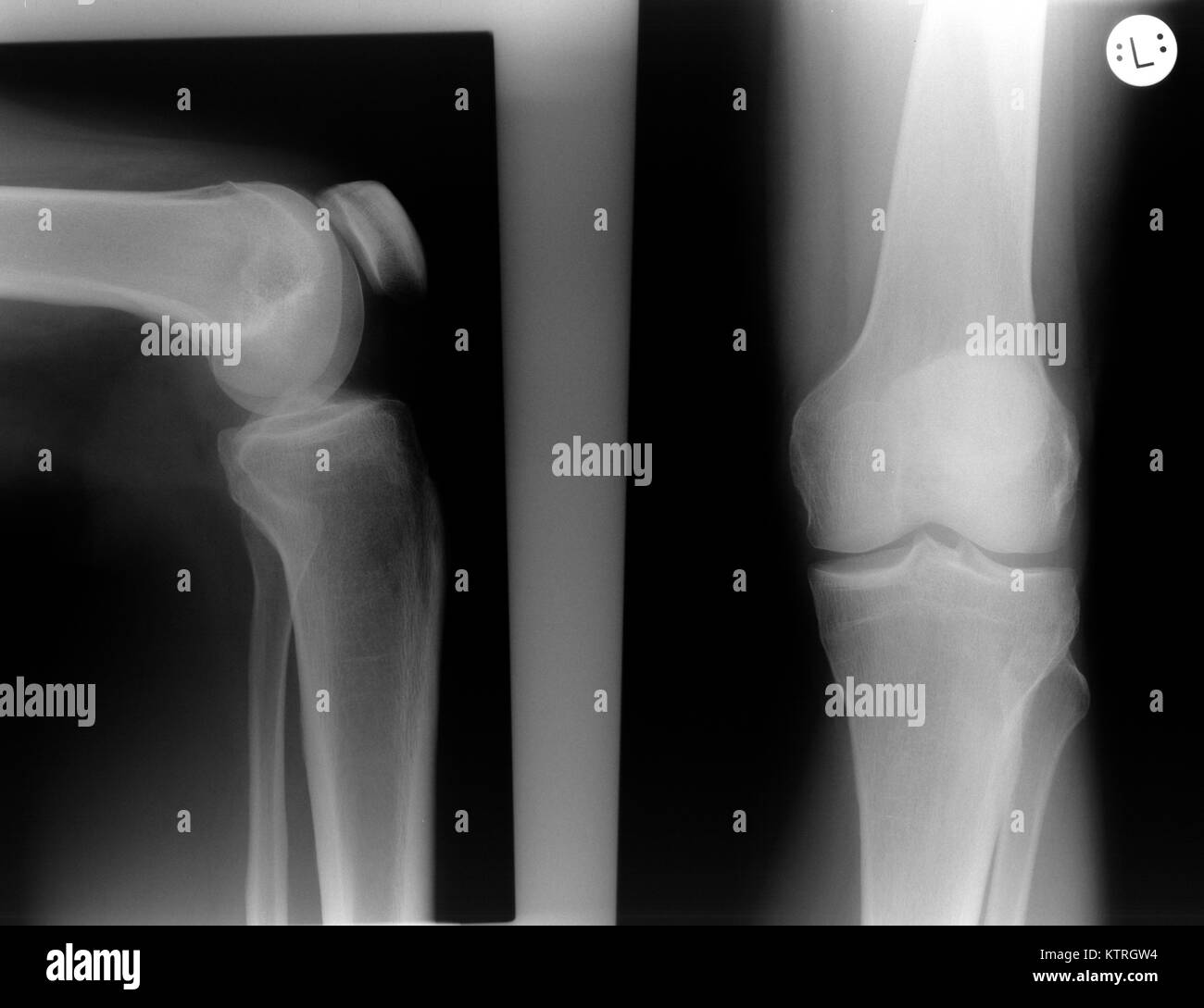 X-ray del ginocchio sinistro di un uomo senza cospicui risultati.  L'immagine a destra mostra il ginocchio dalla parte anteriore (ventrale, ap  - antero-posteriore Foto stock - Alamy