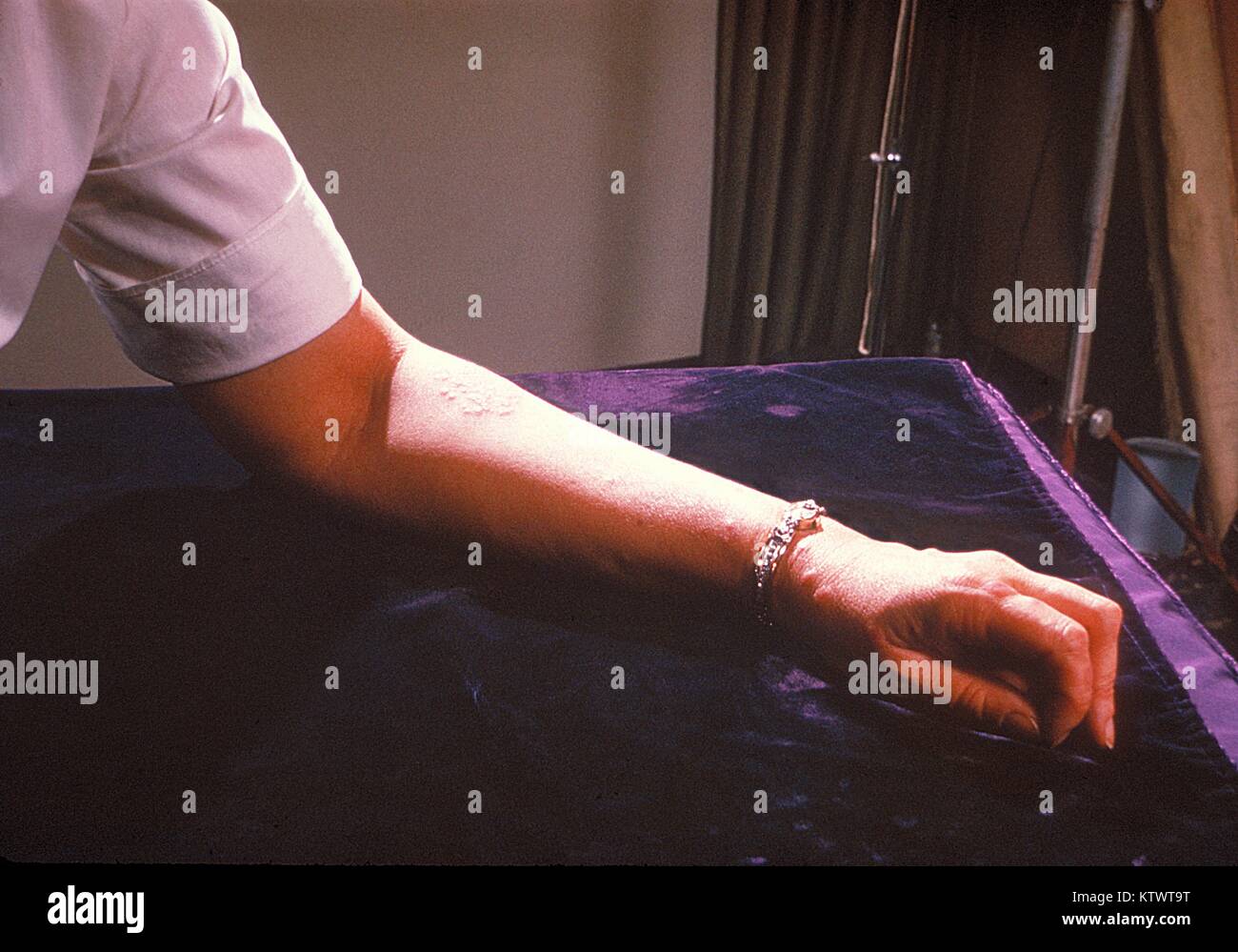 Un paziente?s braccio sinistro rivela la presenza di eritema nodoso. Di solito, eritema nodoso è una sequela secondaria di un altro processo di malattia o a causa di un farmaco reazione di ipersensibilità che si manifesta come gara red protuberanze sulla pelle. Immagine cortesia CDC/Margaret Renz, 1964. Foto Stock
