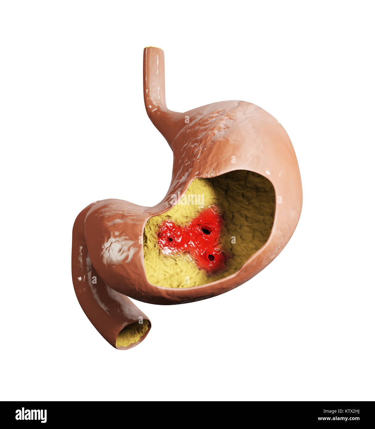 3d illustrazione di ulcera di stomaco. stomaco umano anatomia Foto Stock