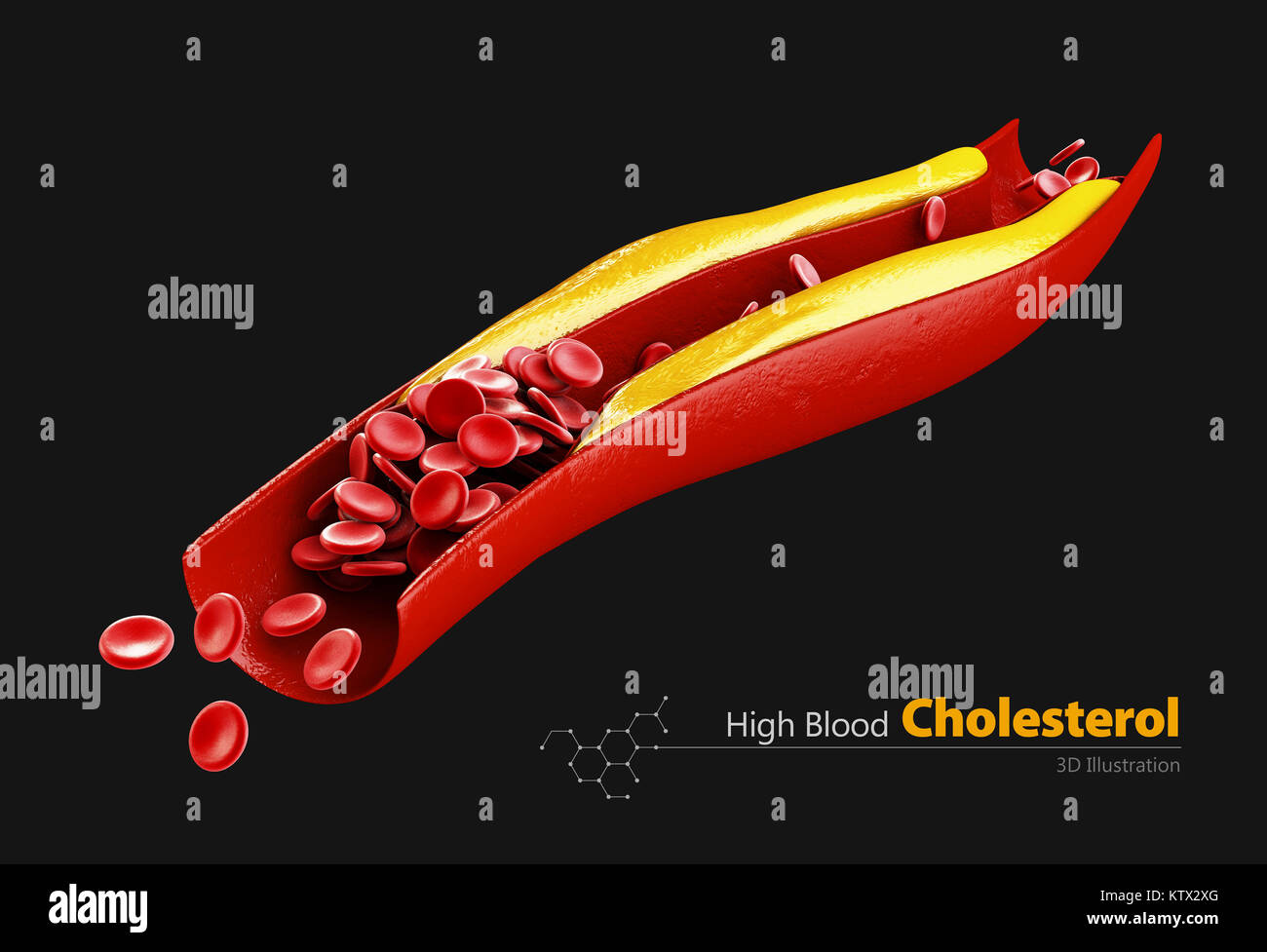 Placca di colesterolo in arteria. 3d illustrazione. isolato nero Foto Stock