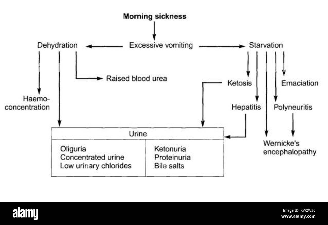 La malattia mattutina si riferisce a una condizione spesso sperimentata da persone incinte, caratterizzata da nausea e vomito, soprattutto nelle prime fasi della gravidanza. Influisce su molti ma varia in gravità. Foto Stock