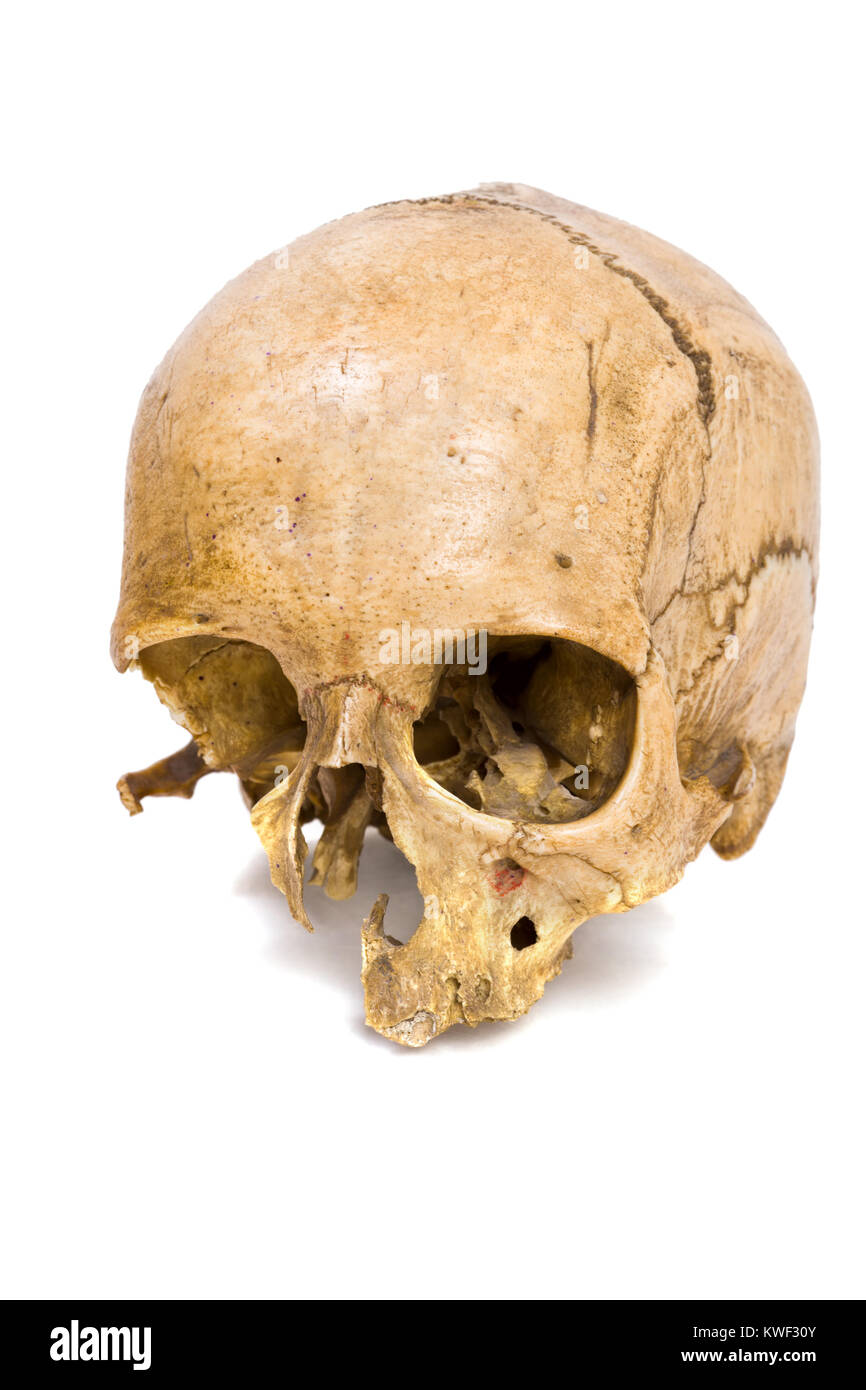 Un vecchio jawless Scull umano isolato su bianco Foto Stock