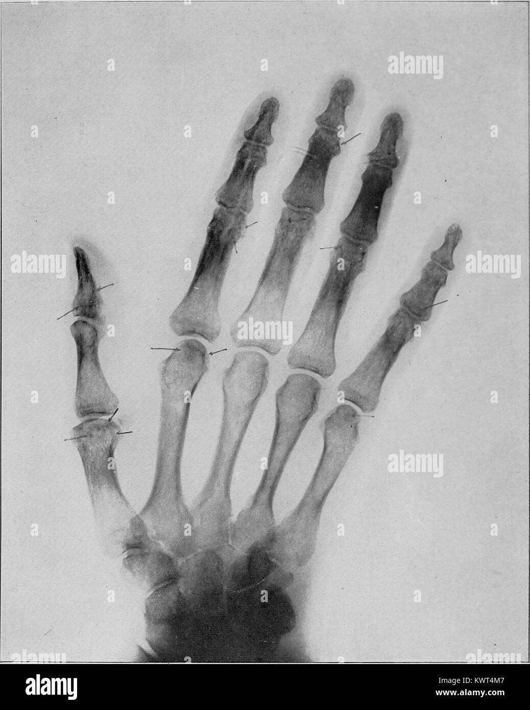 Early medical x ray immagine di una mano, mostrando artrite, 1909. La cortesia Internet Archive. () Foto Stock