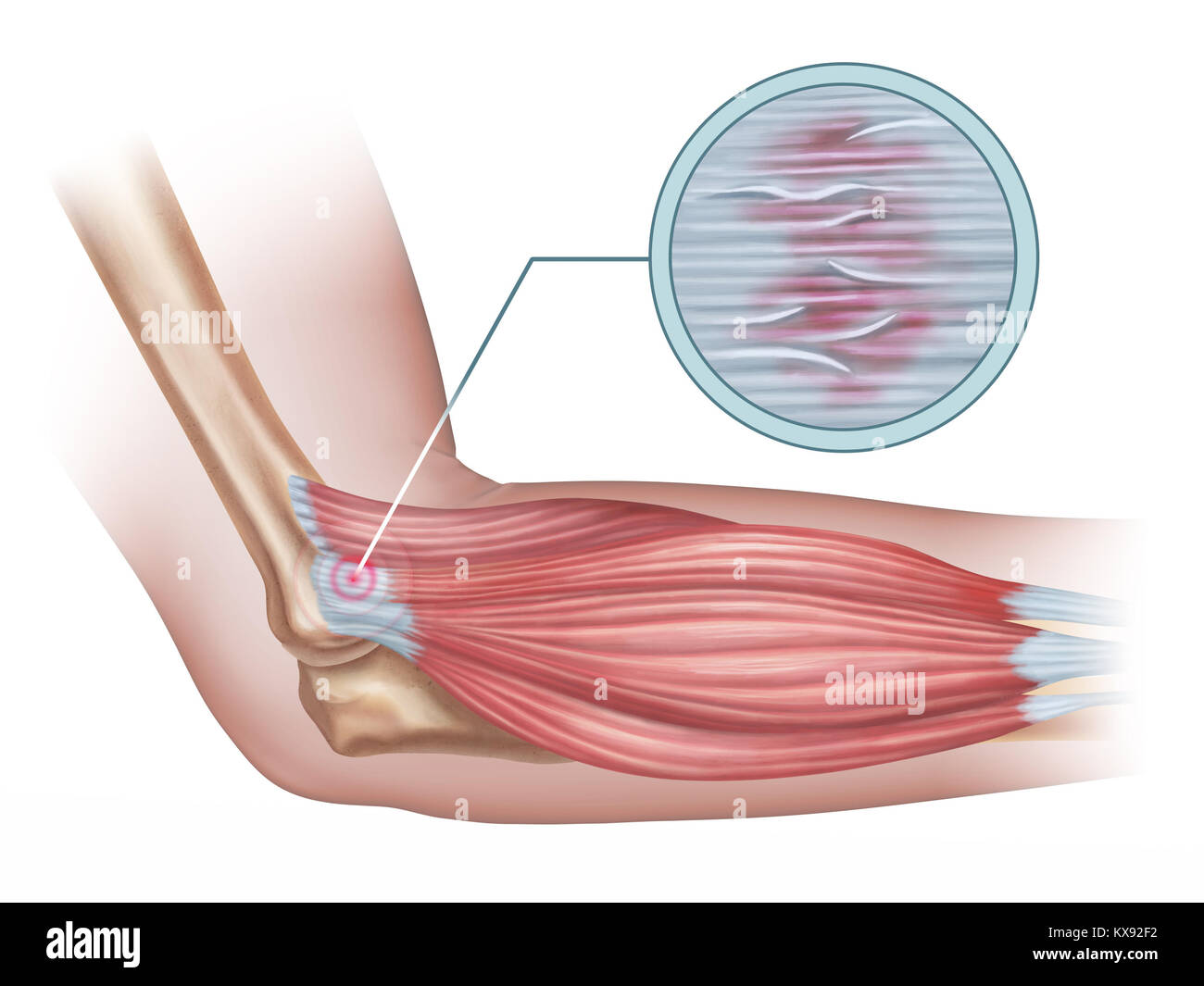 Il gomito del tennista diagramma che mostra un dettaglio del danneggiato tessuto tendineo. Illustrazione Digitale. Foto Stock