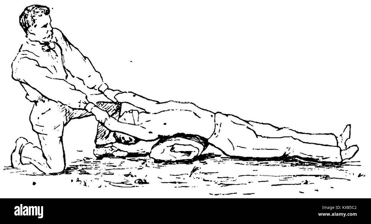 Questa immagine si riferisce al lavoro di Grierson 106a sulla respirazione artificiale, concentrandosi sul metodo Silvestre, una tecnica di ispirazione per aiutare a respirare nei pazienti in difficoltà. Foto Stock