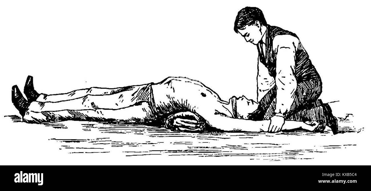 Questa immagine si riferisce allo studio di Grierson 107 sulla respirazione artificiale, incentrato sul metodo Silvestre, una tecnica sviluppata per assistere i pazienti in difficoltà respiratoria. Foto Stock